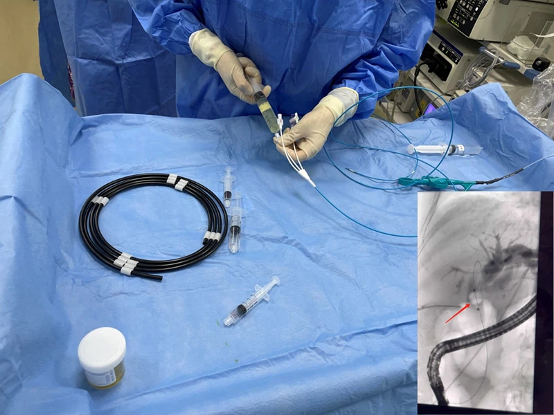 مستشفى هانغتشو المحلي الأعلى ثلاثة يستخدم قسطرة بالون استرجاع الأحجار التي يم...